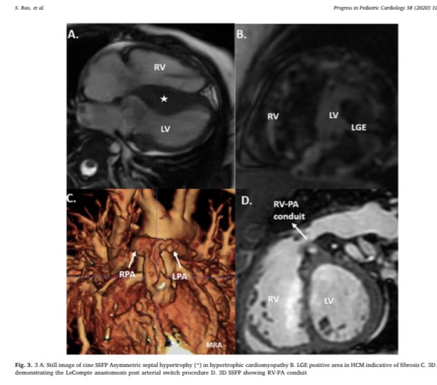 cardiopedhnn's tweet image. RMC y TAC para el cardiologo pediatra.

#whyCCT &amp;amp; #yesCMR for the pediatric cardiologist

#cardiopedia #pedscard #imagen_cardiaca #CHD