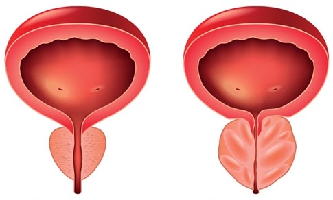 prostateformula's tweet image. What Happens If You Leave an Enlarged cUntreated? bit.ly/enlarged-prost…

#Prostate