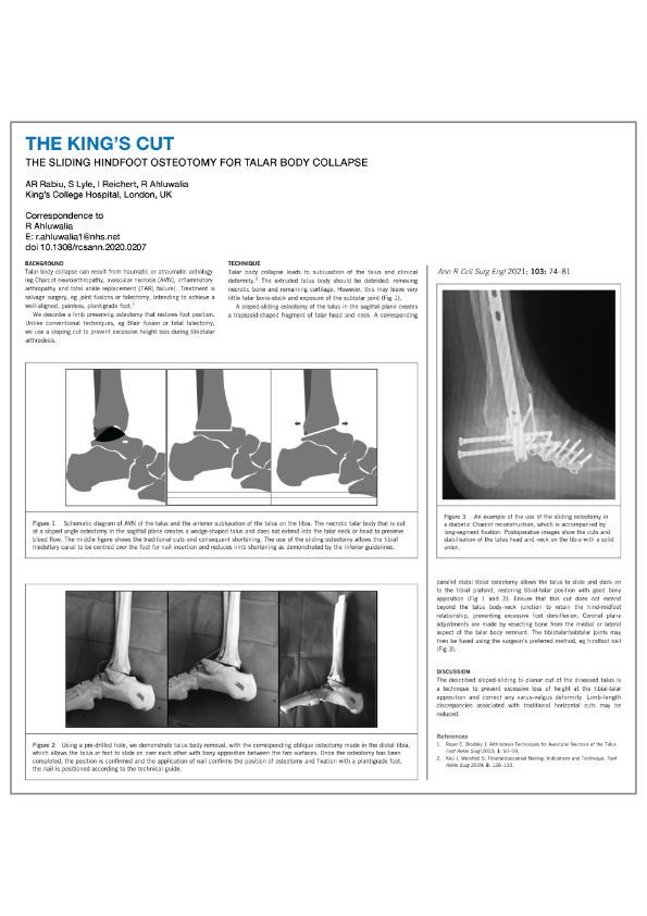 “OrthoSolutions OxBridge nail used in conjunction with long segment fixation. Thanks goes out to Mr Ahluwalia and his team for providing this sliding hindfoot osteotomy paper – “The Kings Cut”. 
Please contact your local sales person for more information.