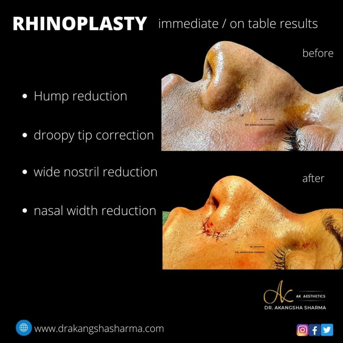 SharmaAkangsha's tweet photo. Hump reduction is the most common rhinoplasty surgery being performed 
#rhinoplasty #nosejob #plasticsurgeoninjaipur https://t.co/Yw6ND0IuhY