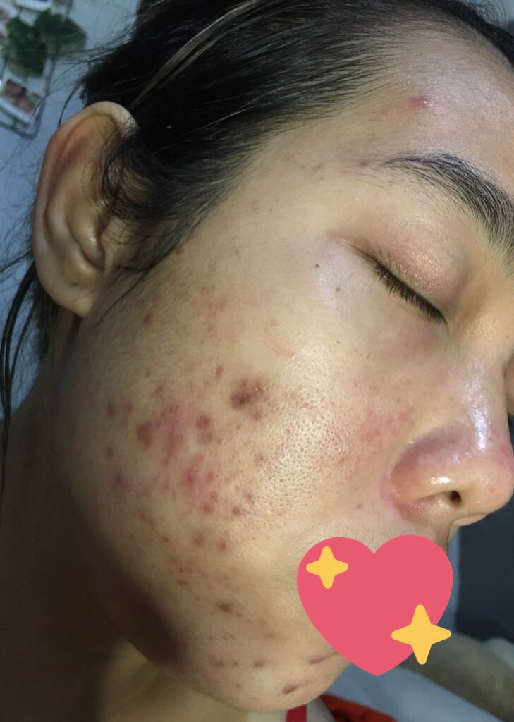 PerempuanLibra's tweet photo. Perjuanganku sebagai “Acne Fighter”

a thread

September 2020    -   Mei 2021 https://t.co/u94R4Nf3uG