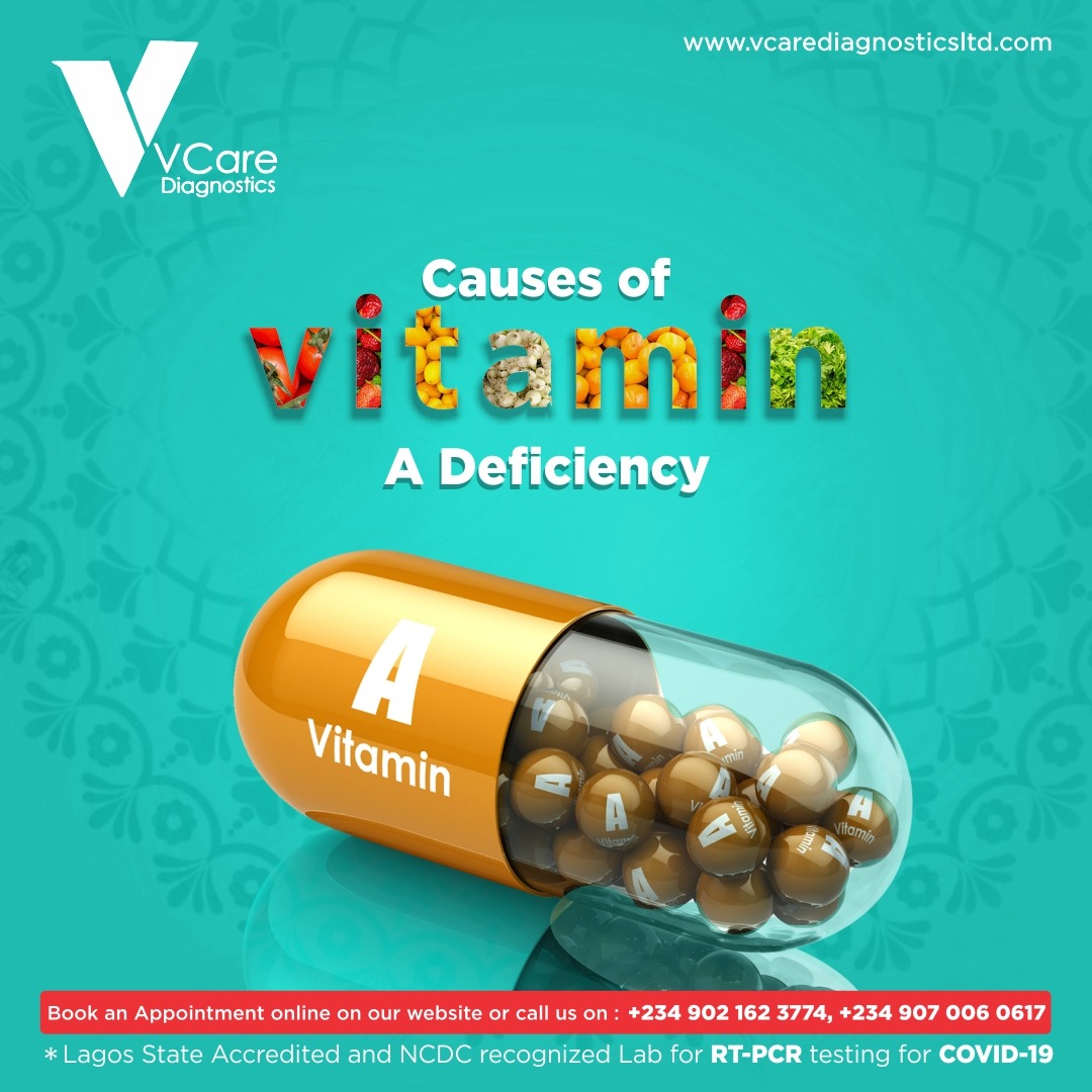 Vitamin A deficiency can result from inadequate intake, fat malabsorption or liver disorders. Deficiency impairs immunity &amp; hematopoiesis &amp; causes rashes and typical ocular effects (eg, xerophthalmia, night blindness).
Walk into #Vcarelab today &amp; let's discuss about your health.