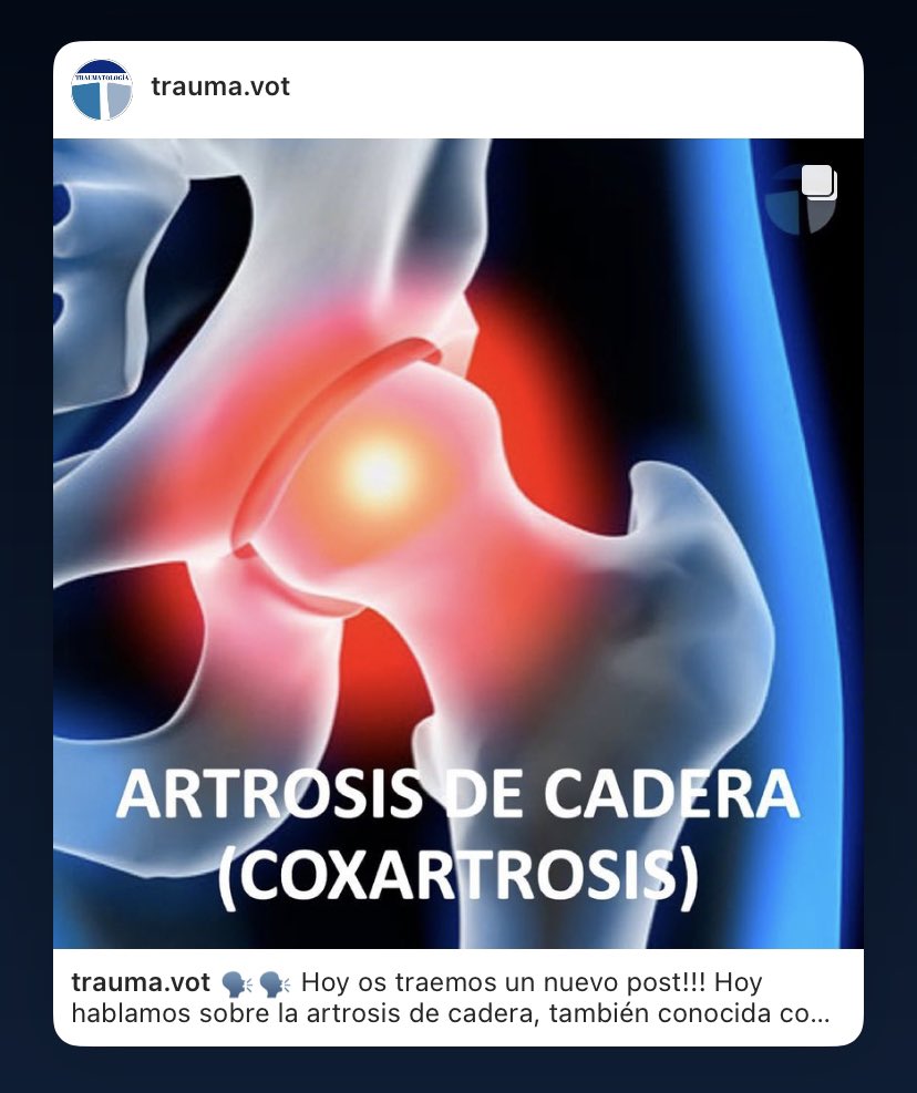 trauma_plus's tweet photo. 🗣 Hoy os traemos un post sobre ARTROSIS DE CADERA, una de las patologías más prevalentes en nuestro medio🦵🏻 y causa de prótesis 🦿

https://t.co/6mb5Dw7XOs

Más post como este en nuestro IG-> trauma.vot

☎️🖥️Para cualquier duda o consulta, no dudes en contactarnos📲💻
#hip #cot https://t.co/Rd0U0RZtC8