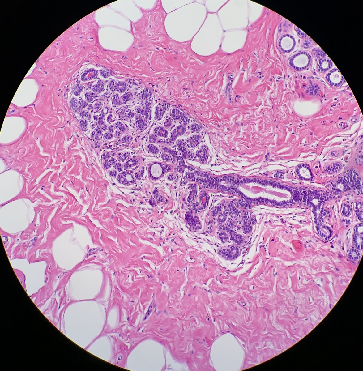lesmes_alvarez's tweet photo. This week we are in the Breast service! Imposible not to capture this beauty 🌷#breastpath #pathart https://t.co/qoiBMTdFYI