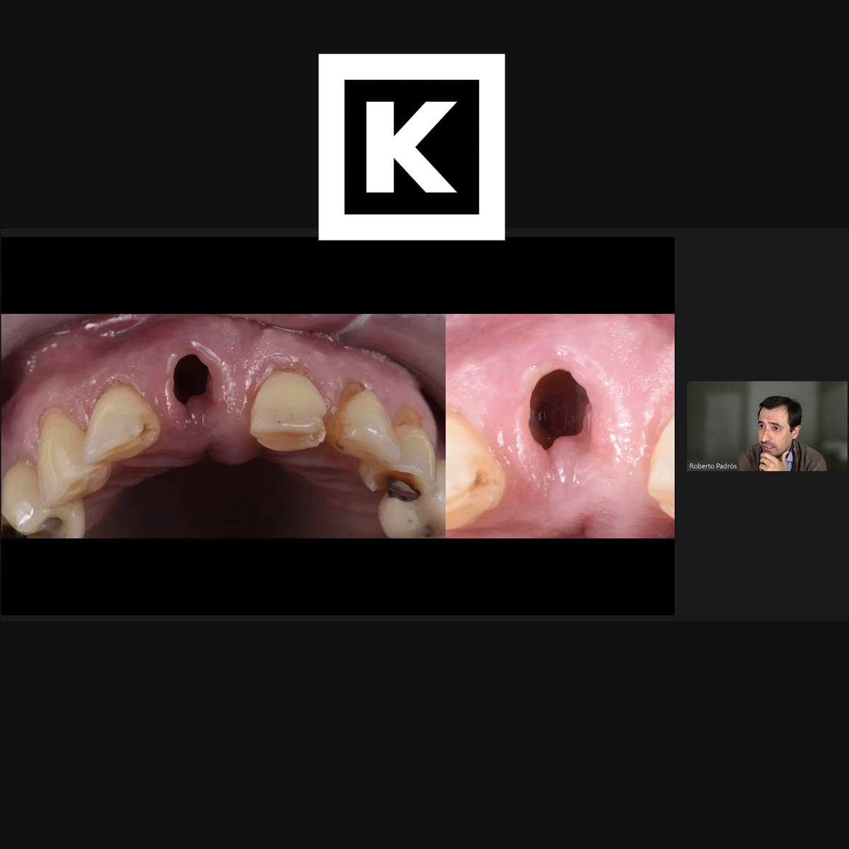 SEPAperiodoncia's tweet image. En directo en el Corporate Fórum de #Klockner

¿Cómo el provisional nos puede ayudar en el manejo de tejidos blandos y en el resultado estético? con Roberto Padrós