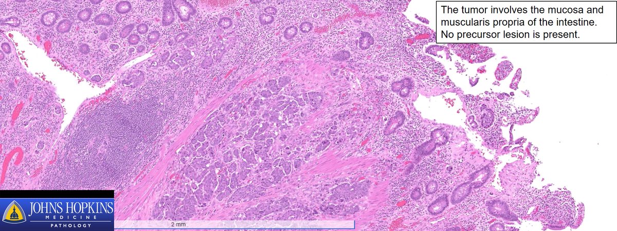 what causes panlobular emphysema