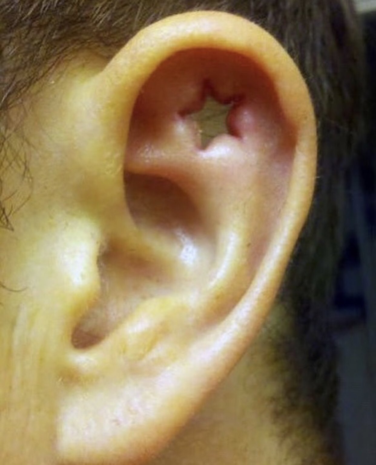 dermal punch ear piercing