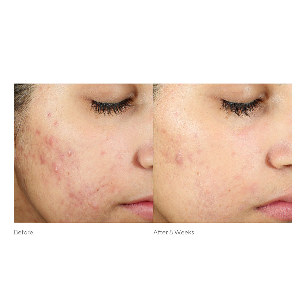 Clear skin giveaway time! Want to win this Acne Kit featuring Invisiscar Resurfacing Treatment to address acne scars? 1000 of you will be randomly chosen to win this 30-day kit ($85 value). ​
.
Want one? Visit bit.ly/30dayacne.