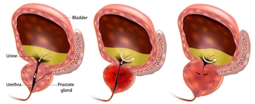 prostateformula's tweet image. How Long does It Take for an Enlarged Prostate to Heal? bit.ly/3hA3TLE

#Prostate