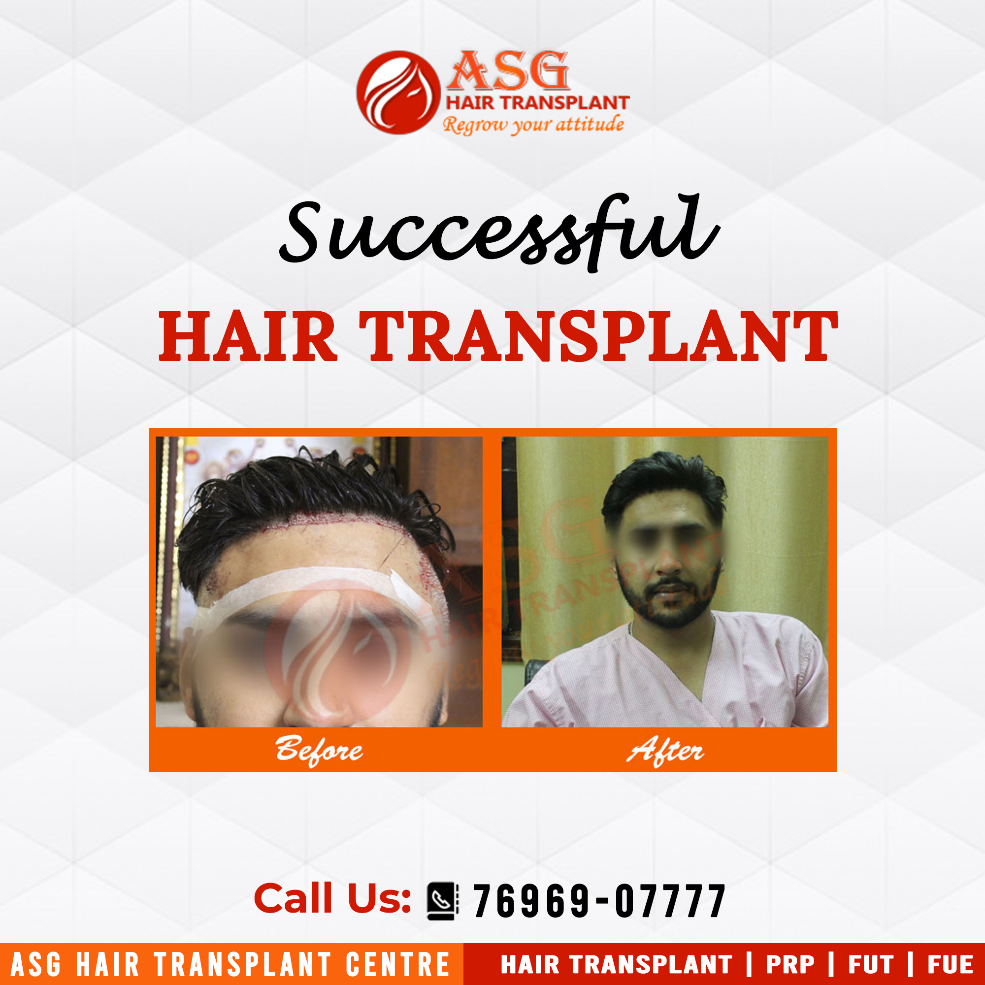 Estimation Of Cost of Hair Transplant in Mota Singh Nagar Jalandhar Asg  Hair Transplant  ID 14340259862