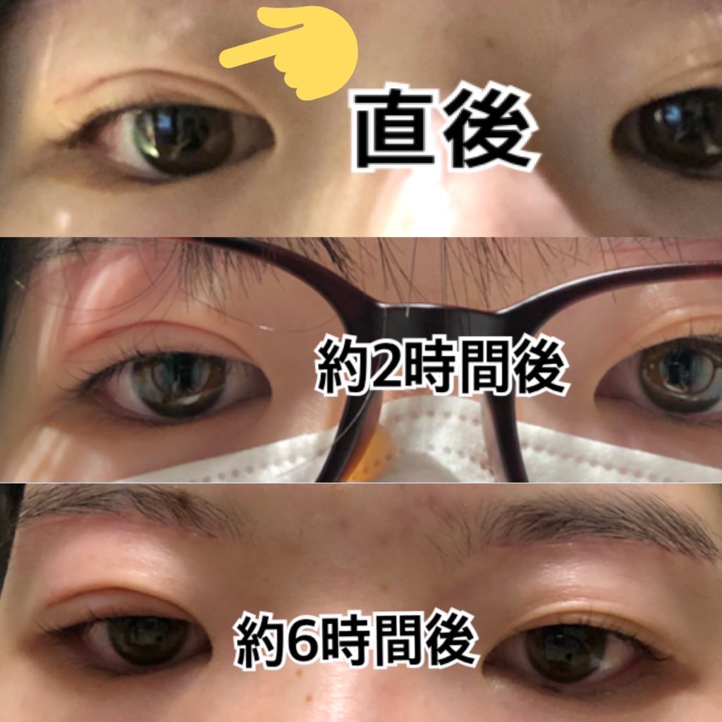 はんぺんクマ取りdt もう今目開いてない 片目だから眼帯して仕事行こうと思ってたのにな笑 埋没 埋没dt T Co Bvduk6pfil Twitter