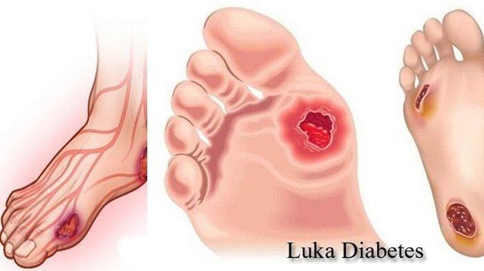 Diabetes tidak bisa disembuhkan.
Kalau kamu terbiasa melakukan:
1. Makan telat/ga teratur
2. Makan junk food/instan teros
3. Soda teros
4. Makan terlalu bnyak karbo/gula
5. Ga pernah olahraga
6. Kurang tidur
7. Ga sarapan
8. Gak suka minum
9. Makan terlalu banyak

Tiati loh yaaa.