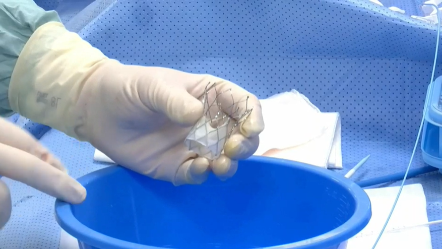 ZeroTLR's tweet photo. The Naviator ( Portico 2) valve was approved in Europe and a case (Lars Sondergard) is on #PCR21 #EuroPCR #EuroPCR2021 #TAVR @PCRonline @EuroInterventio @Ortega_Paz , pacing with wire, on CuspOverlap technique.@AbbottCardio https://t.co/9mHQvGGg4X