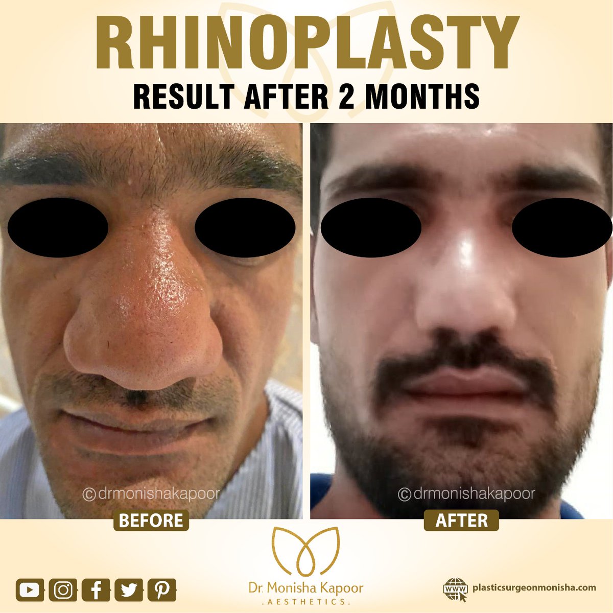 It's not easy to thin a very broad nose with thick skin. But in this patient, you can see that how beautifully at 2 months his nose looks just right for his face. 

#surgery #nosesurgery #nosejobsurgeon #nosejobbeforeandafter #noseshape #revisionrhinoplasty #nosejobrevision