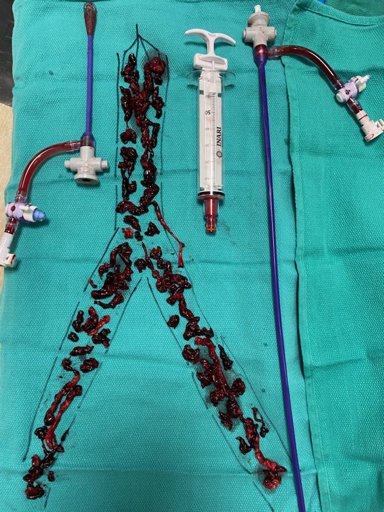 70 YO patient with hematuria requiring 8 unit transfusion after TURP... developed extensive DVT while on prolonged CBI.  Did prostate embo -&gt; urine cleared -&gt; started AC after 3 days -&gt; iliocaval / iliofemoral thrombectomy with T20 from pop access on day 5 post embo.  #iRad