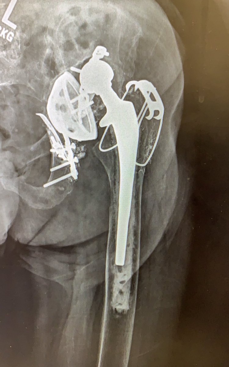 Lee E. Rubin, M.D., FAAOS, FAAHKS, FAOA (@drleerubin) on Twitter photo <a href="/wayniackmd/">Wayne Moschetti MD, MS</a> Always amazing what pathology “walks in” to the office!
Is your patient somehow related to this 96yo patient, who showed up in my practice this week... almost no discomfort. Walks to bathroom without much difficulty. <a href="/wayniackmd/">Wayne Moschetti MD, MS</a> Always amazing what pathology “walks in” to the office!
Is your patient somehow related to this 96yo patient, who showed up in my practice this week... almost no discomfort. Walks to bathroom without much difficulty.