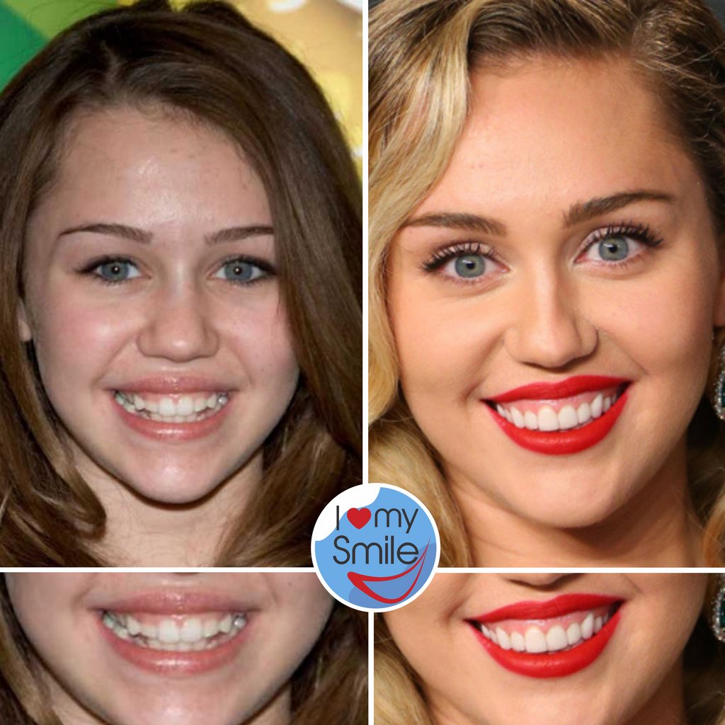 Miley Cyrus Teeth