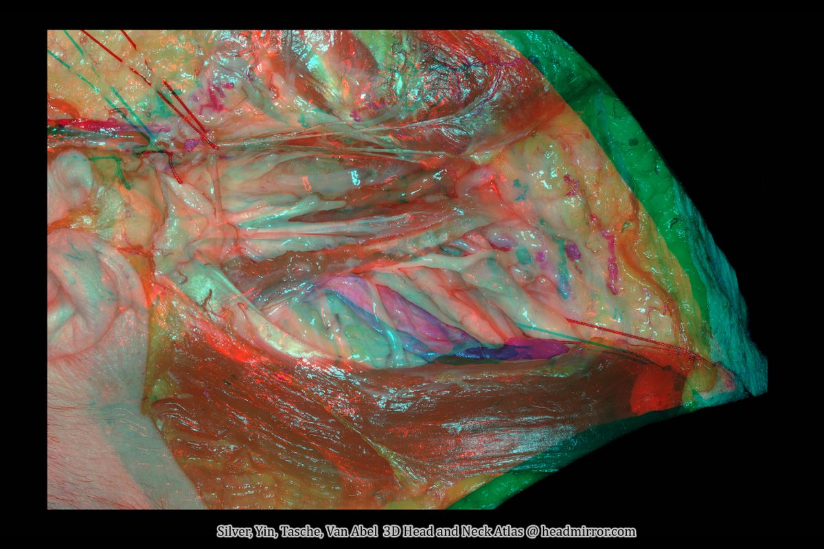 Our 3D Atlas now includes images for Head and Neck. Here’s Chapter 1: Parotidectomy &amp; Parapharyngeal Space. The 3D Atlas helps contextualize the depth of important landmarks of common ENT surgeries. Grab your 3D glasses--more Head and Neck images to come! headmirror.com/headneck-atlas…