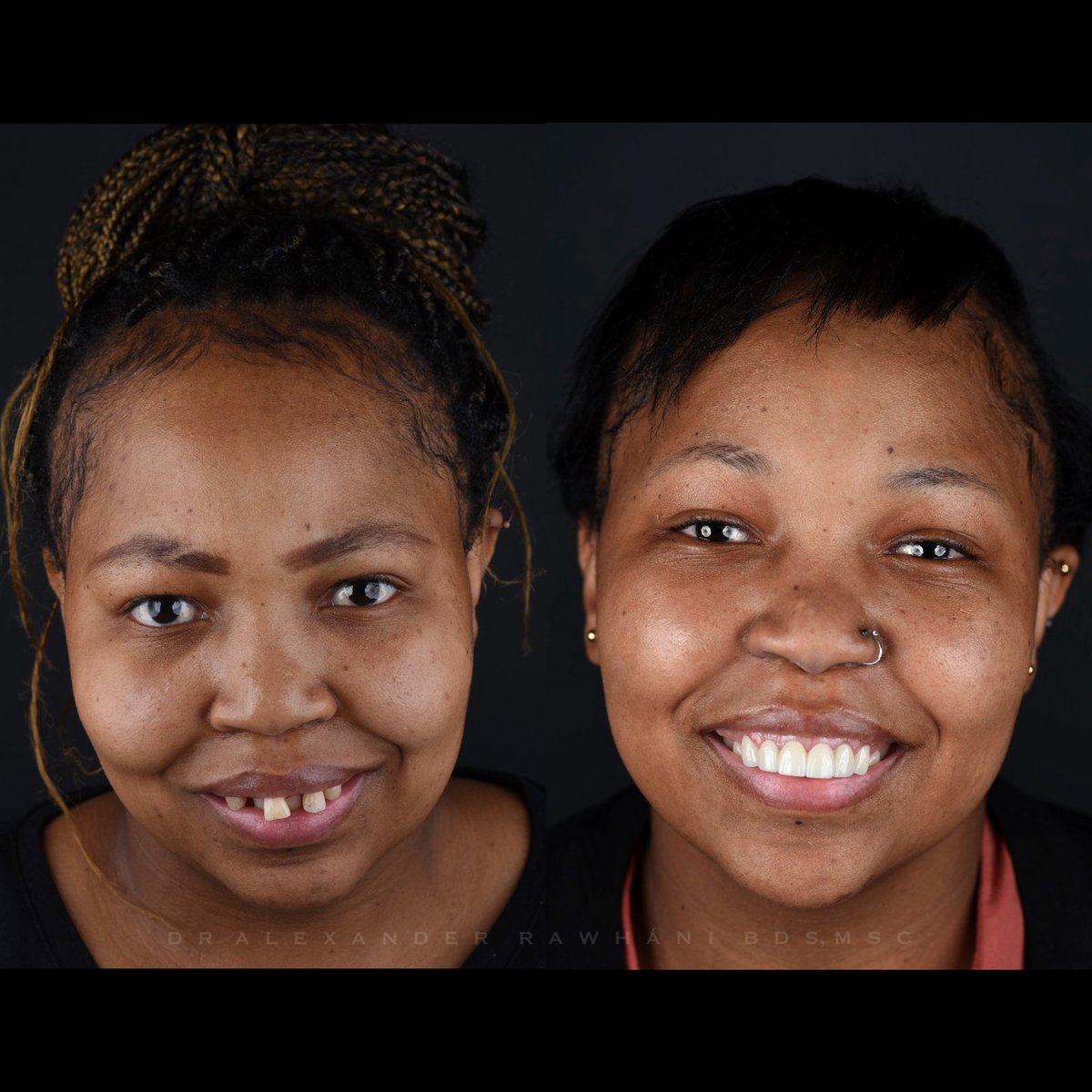 drsmileafrica's tweet photo. Project Smile South Africa ๐จ๐ปโโ๏ธ๐ฆท๐ฟ๐ฆ
At your service ~ ๐๐ ๐ฎ๐๐พ๐๐ยฎ ๐จ๐ปโโ๏ธโค๏ธ๐ฆท๐ฟ๐ฆ
#PROJECTSMILESA https://t.co/RGnxv4UvuQ