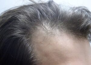 What Is Male Pattern Baldness and Can It Be Treated  Hair  Skin Science