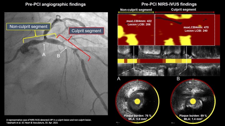 The characteristics of coronary lipid-rich plaques in Asian patients with #cvACS and stable angina. Read more:

bit.ly/3x3H7RI

#cvImaging #Cathlab #CardioTwitter #TweetTheJournal

@Dominik_Linz  @ELS_Cardiology  @ElsevierNews @BetzKonstanze