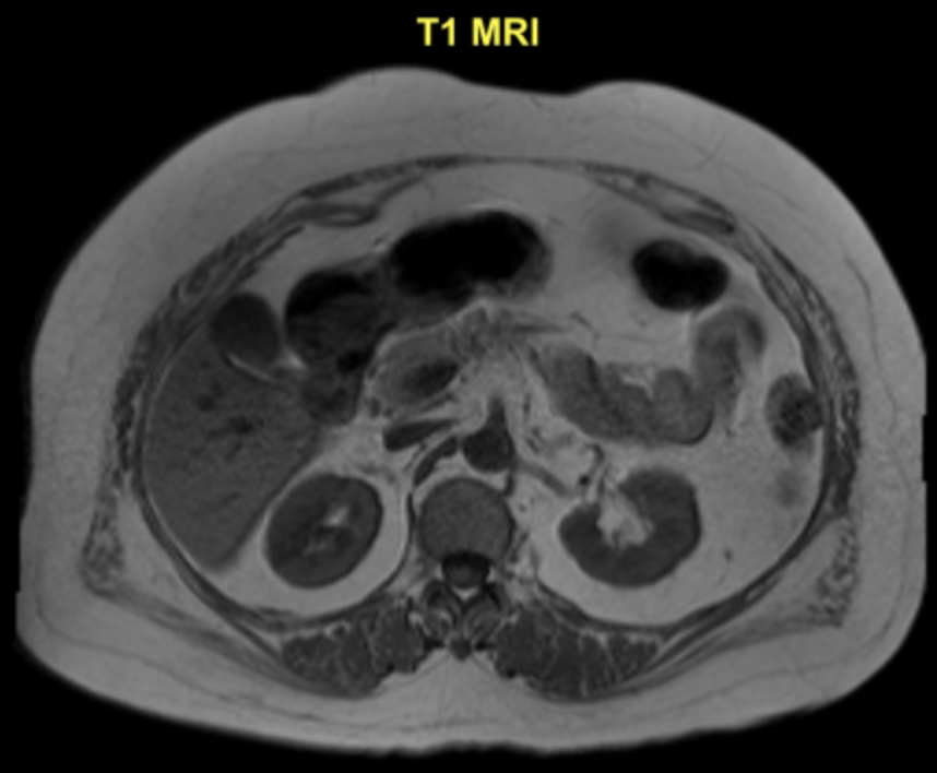 кт забрюшинного пространства малого таза. лимфангиома забрюшинного пространства мрт. забрюшинное пространство малого таза. кт забрюшинного пространства малого таза. кт брюшного и забрюшинного пространства.