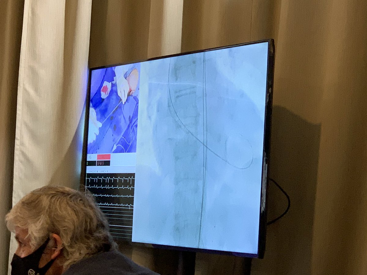 belcid7's tweet photo. Now live on Valvular channel 
#EuroPCR 

🫀Tips and tricks for a successful TAVI procedure  

@PCR_MadridHub @PCRonline 

@ramirotrillo @icruzgonzalez @PJimenezQueved1 @luisnombela @McInerneyAngela @ignamatsant @NievesGonzalo1 @JEscaned https://t.co/VNvlEFz5vn