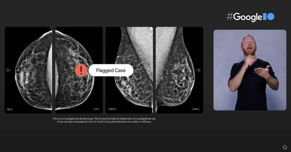 Very exciting to see our team <a href="/GoogleHealth/">Google Health</a>'s breast cancer imaging work presented at #GoogleIO2021 with prospective studies starting at <a href="/NorthwesternMed/">Northwestern Medicine</a>. Watch the short video clip presented by @KBDeSalvo here youtu.be/Mlk888FiI8A?t=…