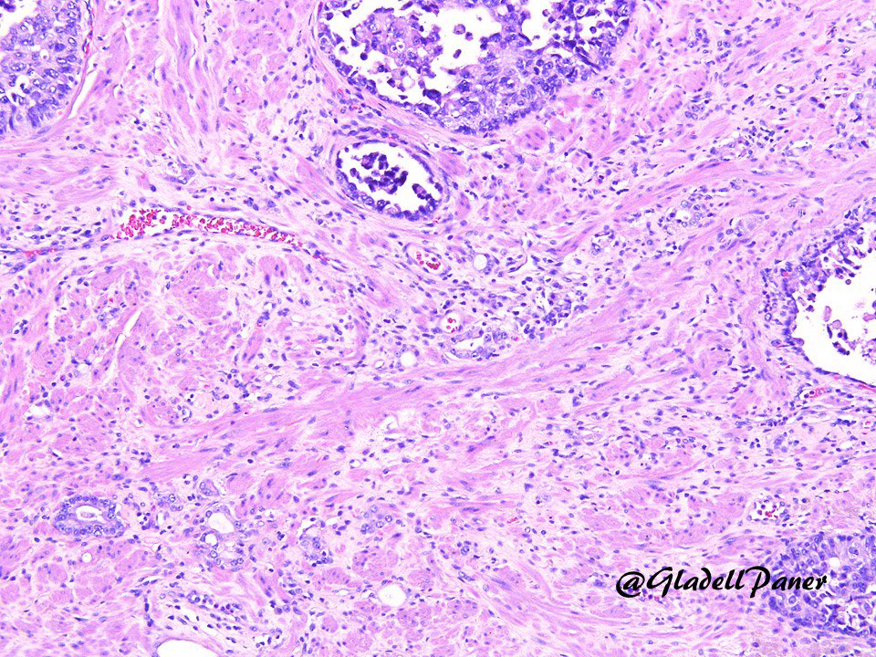 GladellPaner's tweet photo. What’s your diagnosis in this prostatectomy? Answer in comment. #GrayZonePath #GUPath https://t.co/Z9NQllhAA5
