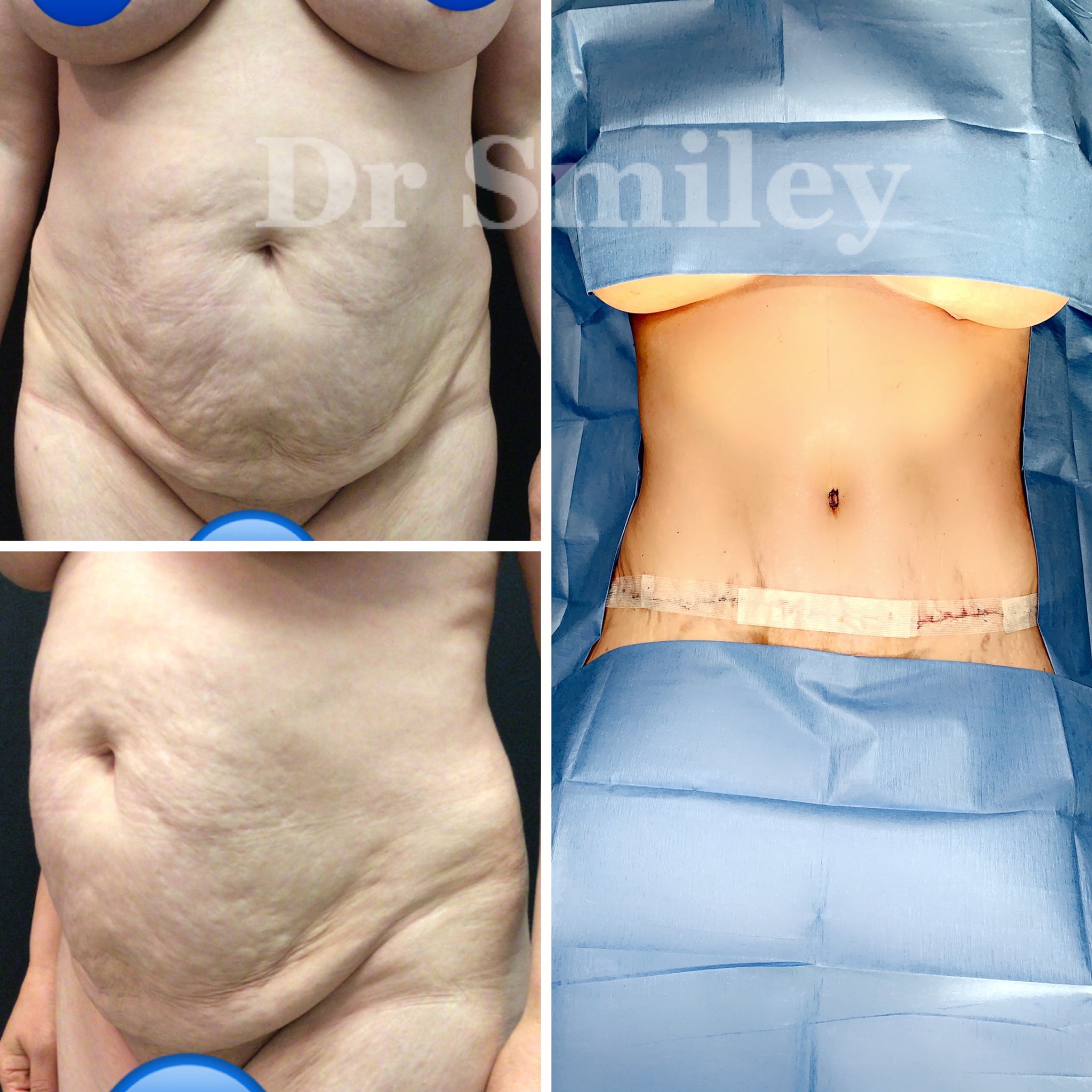 Does tummy tuck remove stretch marks