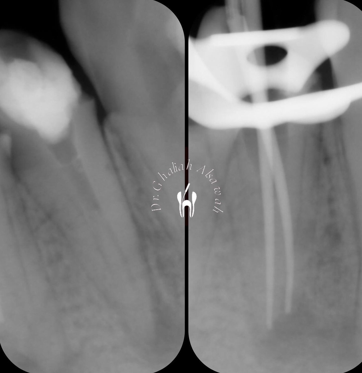 drg_alsawah's tweet photo. A Rare case of a lower premolar with one root &amp; 3 canals 😍 
#drghaliahS https://t.co/iNUGOU652J