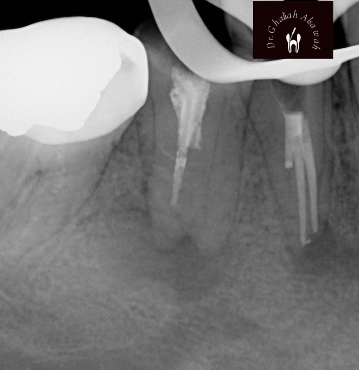 drg_alsawah's tweet photo. A Rare case of a lower premolar with one root &amp; 3 canals 😍 
#drghaliahS https://t.co/iNUGOU652J