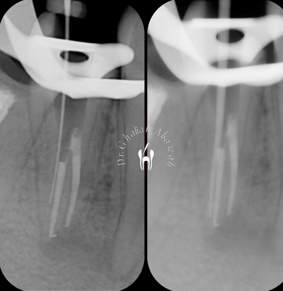 drg_alsawah's tweet photo. A Rare case of a lower premolar with one root &amp; 3 canals 😍 
#drghaliahS https://t.co/iNUGOU652J