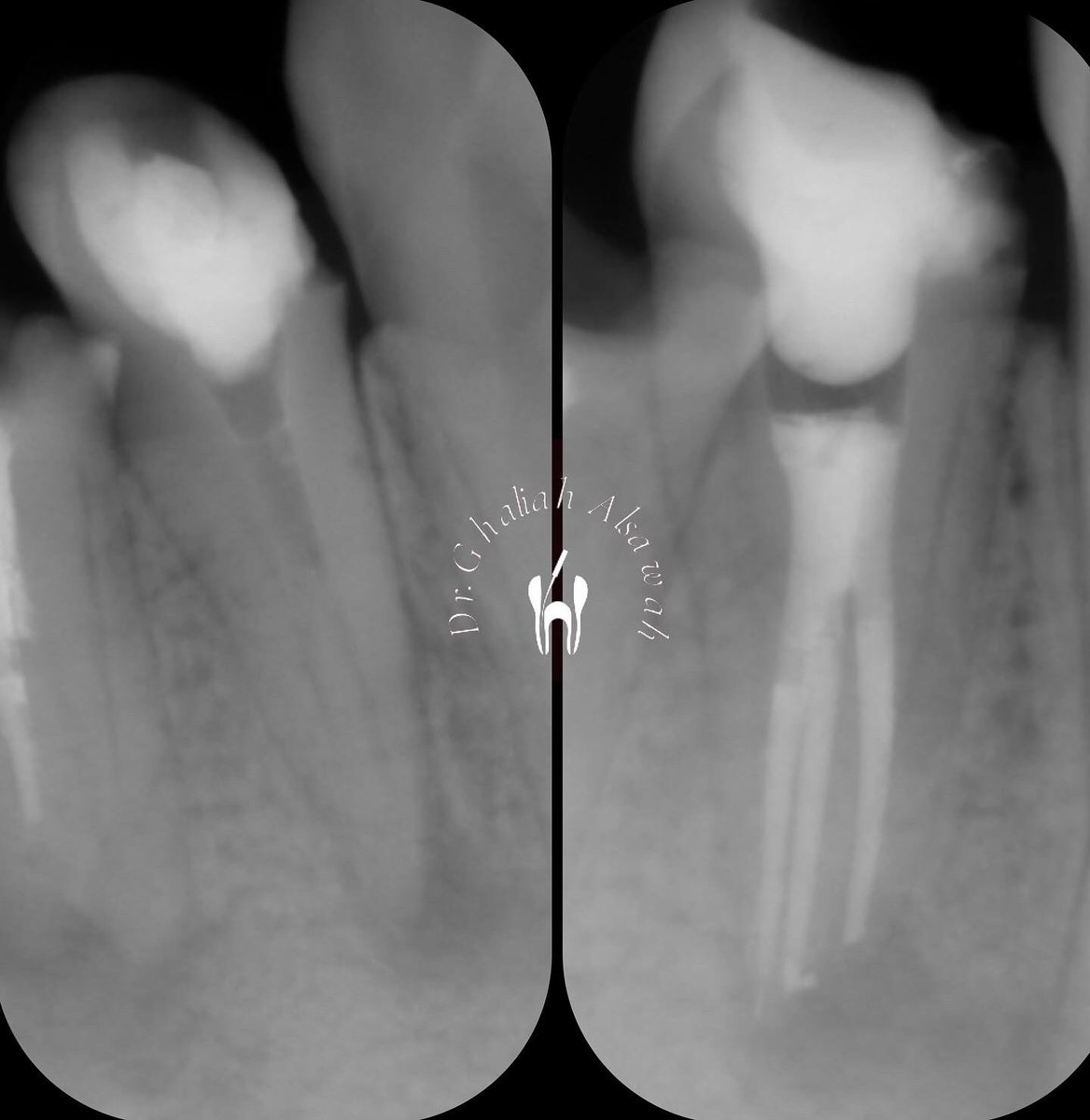 drg_alsawah's tweet photo. A Rare case of a lower premolar with one root &amp; 3 canals 😍 
#drghaliahS https://t.co/iNUGOU652J