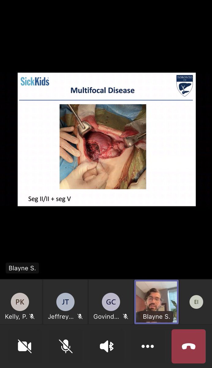 Eyad Issa (@eyadissa) on Twitter photo Very informative talk about pushing the boundaries in paediatric liver surgery by the inspiring @BAmirSayed what a great place to train <a href="/UHN/">University Health Network</a> <a href="/SickKidsNews/">The Hospital for Sick Children (SickKids)</a> <a href="/TorHPBFlwshp/">TorontoHPBFellowship</a> <a href="/TVASurg/">TVASurg</a> Very informative talk about pushing the boundaries in paediatric liver surgery by the inspiring @BAmirSayed what a great place to train <a href="/UHN/">University Health Network</a> <a href="/SickKidsNews/">The Hospital for Sick Children (SickKids)</a> <a href="/TorHPBFlwshp/">TorontoHPBFellowship</a> <a href="/TVASurg/">TVASurg</a>