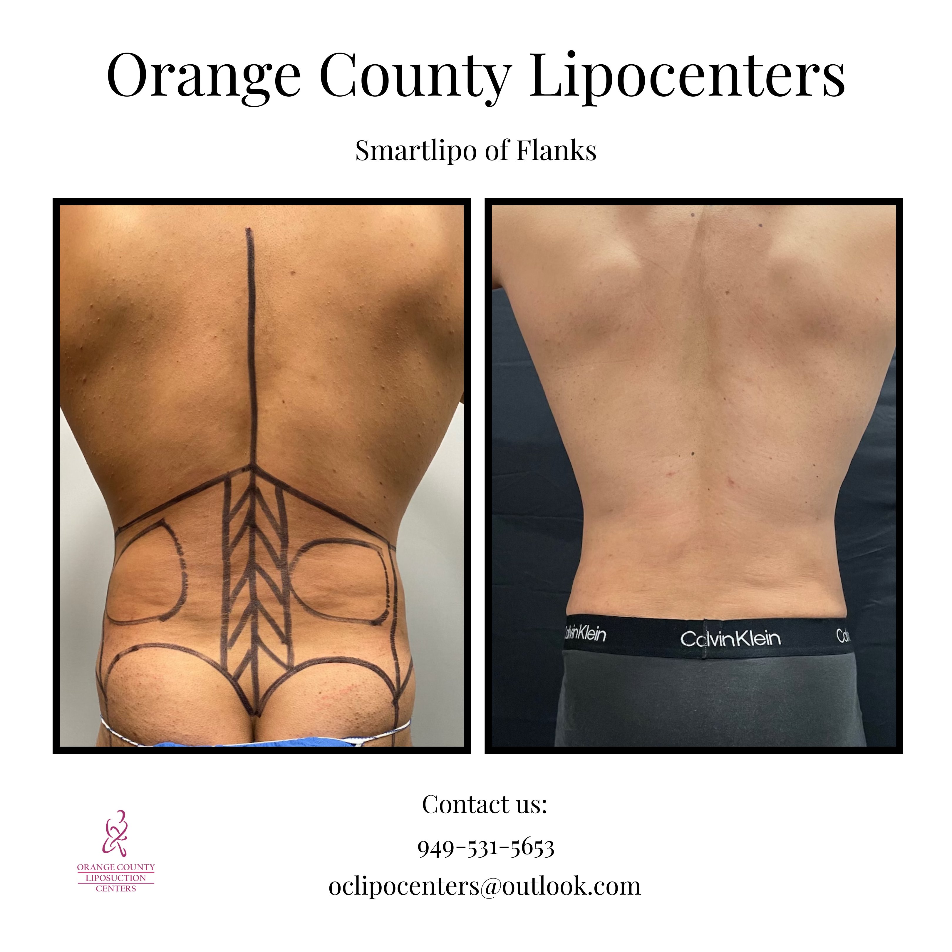 Los Angeles Liposuction Centers on X: Male patient came in for Smartlipo  of his flanks. He wanted to achieve a muscular, more defined look.  Smartlipo is an amazing procedure not only for