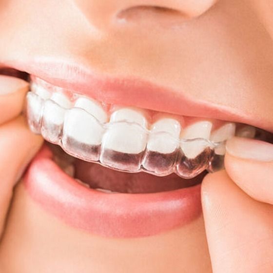 MommyComper's tweet photo. shared: Why Invisalign and is it worth it?
https://t.co/icjogmrzdf https://t.co/BkZFBA48Ay