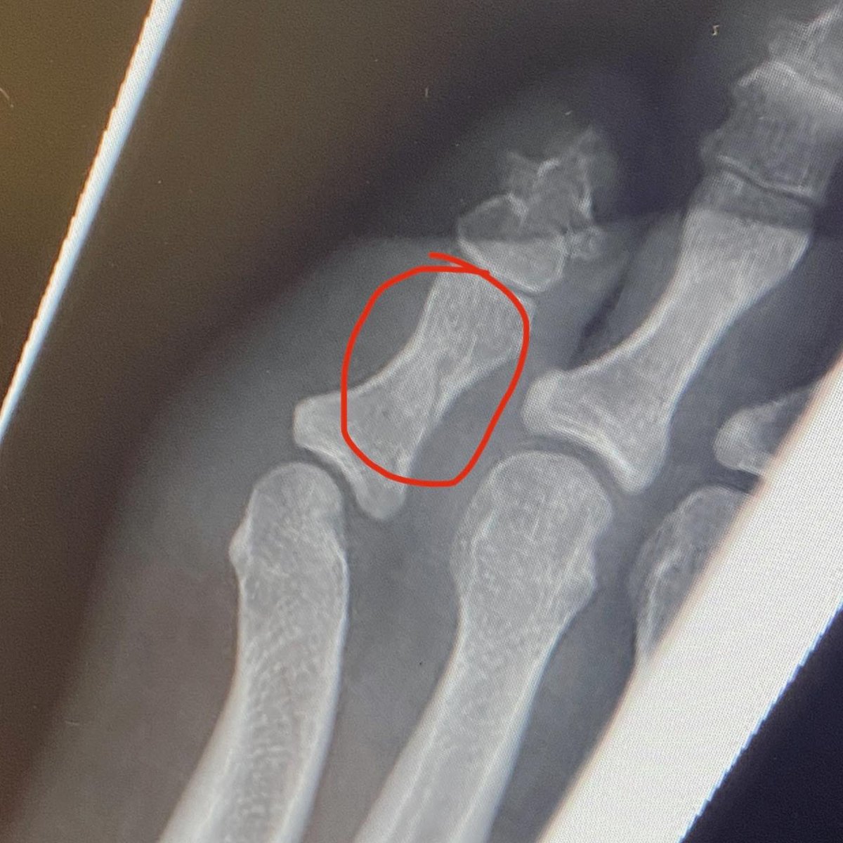 lou_c_getsfit's tweet photo. Confirmation - Toe Fracture so I took my ass to the gym!
Ultra Marathon 17 Sleeps - it is happening no matter what!!
#ultra #ultramarathon #fracture #toefracture #running #ukrunchat https://t.co/l0KIe5p0fF
