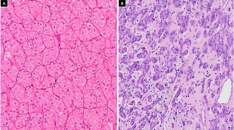 .<a href="/oleks_kravtsov/">Oleksandr Kravtsov</a> et al. show that LOT is an indolent eosinophilic renal neoplasm that constitutes ∼ 4% of tumors diagnosed as oncocytoma. 

The morph, phenotypic, &amp; mol features of this neoplasm suggest it is a distinct entity of renal neoplasia 

sciencedirect.com/science/articl…