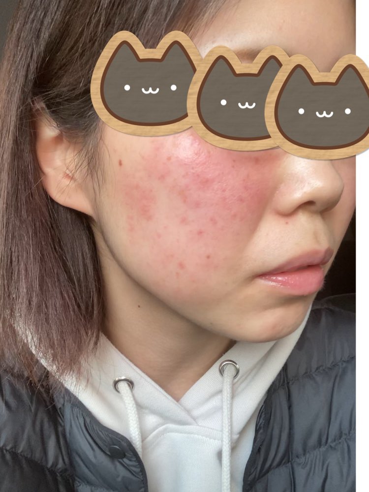 てんてん 酒さ治療中 Tenten Hadaare Twitter