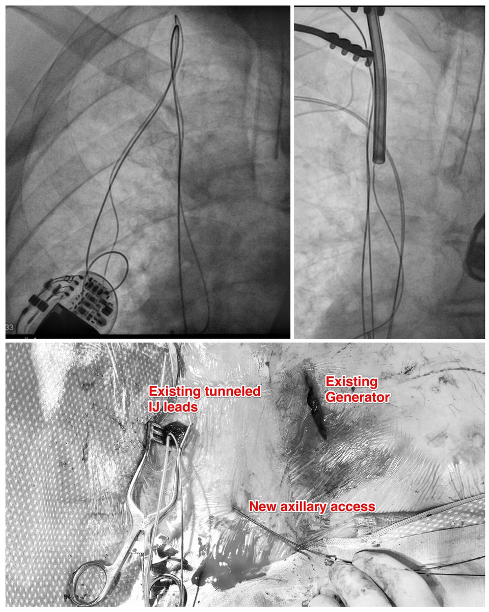 20yr old fractured brady leads implanted R IJ and tunneled down to very inferior generator. Needed new PPM and MRI-conditional system. Successful complete extraction and re-implant via R axillary. Amazing field and techniques we have. #EPeeps #cardiotwitter