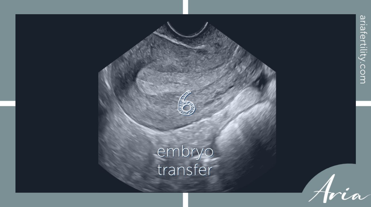 We may suggest that a single embryo is transferred particularly if:
• you're <37 YO; have good quality embryos; have had previous multiple pregnancies.

#ivf #ivfuk #ivflondon #ivfcliniclondon #fertility #infertility #fertilitycliniclondon #fertilityuk #fertilitysupport #ivfhelp