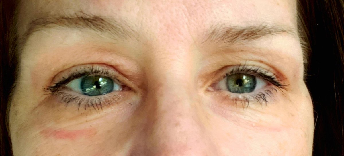 A 1.25mi swim leaves SERIOUS Goggle Eyes. Needed to show myself I'm ready for a 750m swim for my upcoming sprint tri. So I swam my fastest 50yd warmup, then swam 2,150yds more wo resting. Now I feel I'm almost ready for 750m (820 yds or almost a half-mile) strava.com/activities/540…