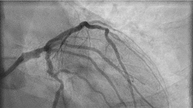 aidanmoleary's tweet photo. When is One Stent enough? Join our Live Left Main #Bifurcation Case Series. Part 5 on June 10th will focus on Provisional LM #Stenting -Register now for FREE! https://t.co/SJKSIQtKEW Click now to watch Part 1 to 4 of this step-by-step #LeftMain educational journey. #cardiotwitter https://t.co/0bV1dkZLJ3