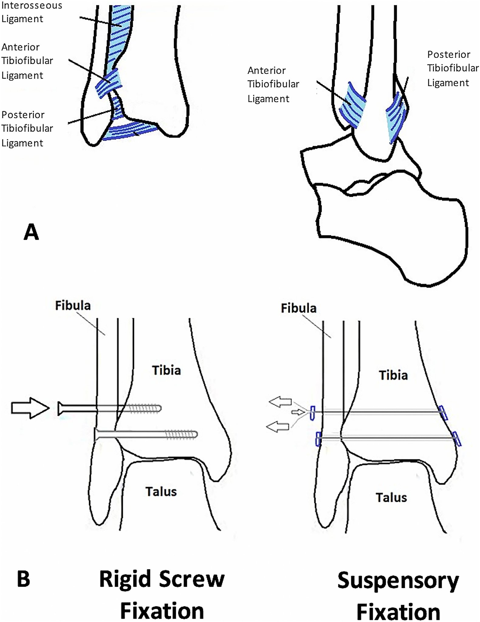J Bone & Joint Surg on Twitter: "Syndesmosis Repair Affects in Vivo Distal  Interosseous Tibiofibular Ligament Elongation Under Static Loads and During  Dynamic Activities https://t.co/uDKcfJeN17 https://t.co/E9APWPjxWi" /  Twitter