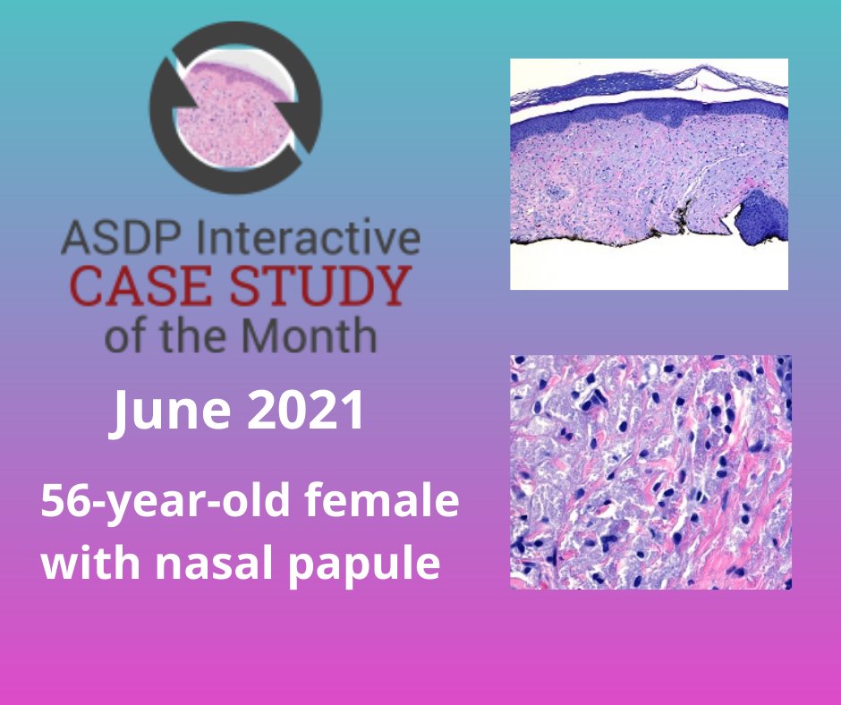 American Society of Dermatopathology (@asdptweets) on Twitter photo Make the Dx: June #ASDPCaseStudy
asdp.org/education/case…
<a href="/uthsc/">The University of Tennessee Health Science Center</a> Make the Dx: June #ASDPCaseStudy
asdp.org/education/case…
<a href="/uthsc/">The University of Tennessee Health Science Center</a>