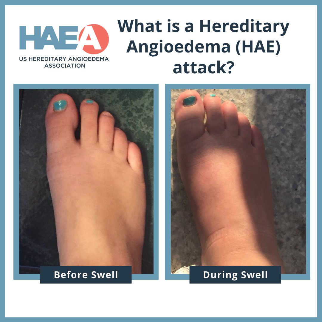 Angioedema Before And After