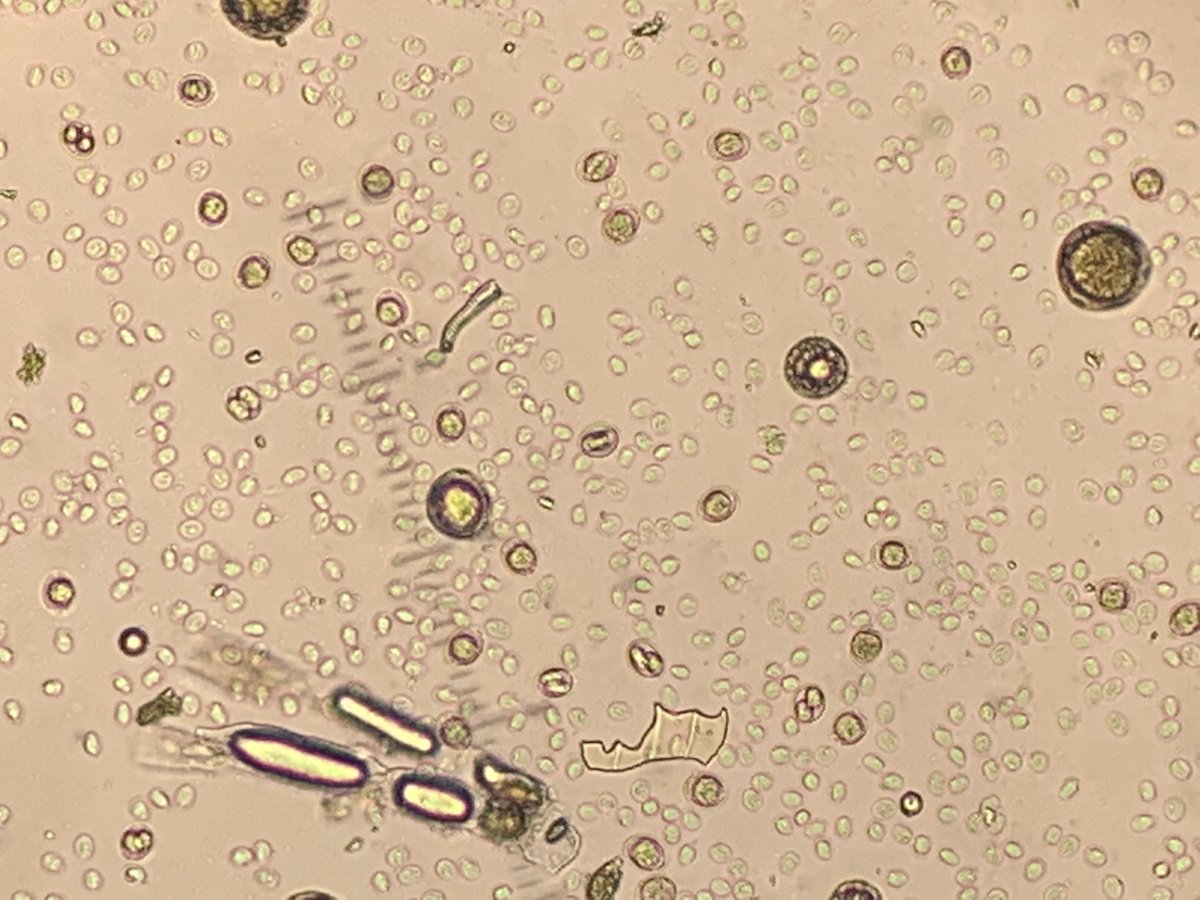 UTParasitePulse's tweet photo. This is a centrifugal flotation with zinc sulfate solution run (here in the lab) on the fecal of a 15 week old puppy, referring veterinarian was getting Giardia Snap positive but multiple O &amp; P exams (fecasol passive flotation) reportedly negative.  What is your diagnosis? https://t.co/CqlTA37Qhw