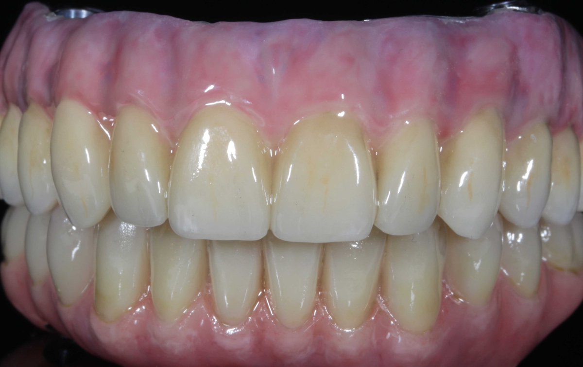 CeramicDesignsL's tweet photo. Our taco bridges are going from strength to strength!
#ceramicdesignslab #digitaldentistry https://t.co/uYdiQRLsFW