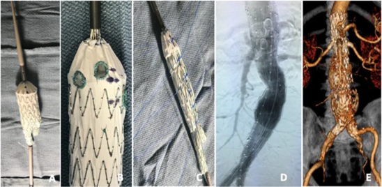 📢New article📢
Clinical application and technical details of cook zenith devices modification to treat urgent and elective complex #aortic #aneurysms | cvirendovasc.springeropen.com/articles/10.11… #irad <a href="/JmanungaMD/">Jesse Manunga</a> <a href="/LBEisenmenger/">Laura Eisenmenger, MD</a> <a href="/MHIF_Heart/">Minneapolis Heart Institute Foundation</a>